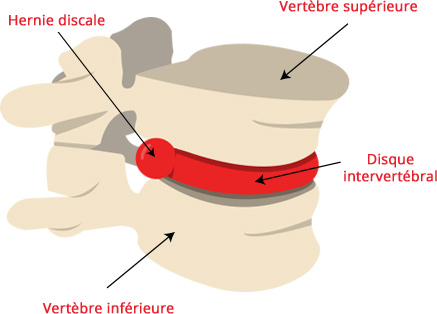 hernie-discale-et-sciatique